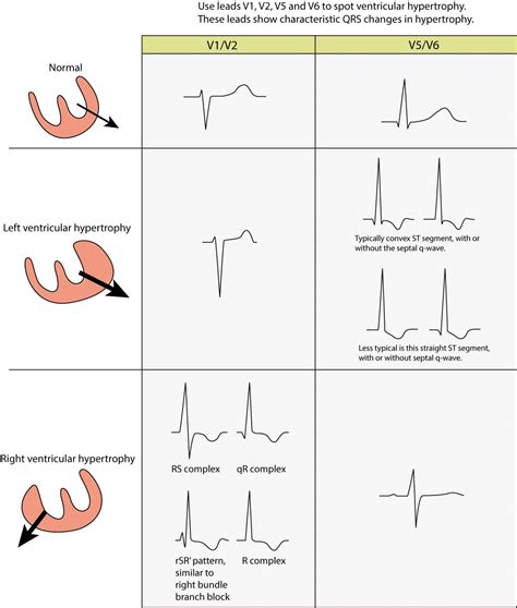 left ventricular hypertrophy test results